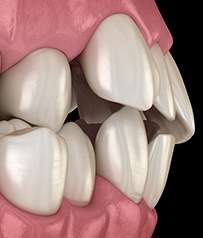 Invisalign