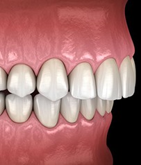 Invisalign