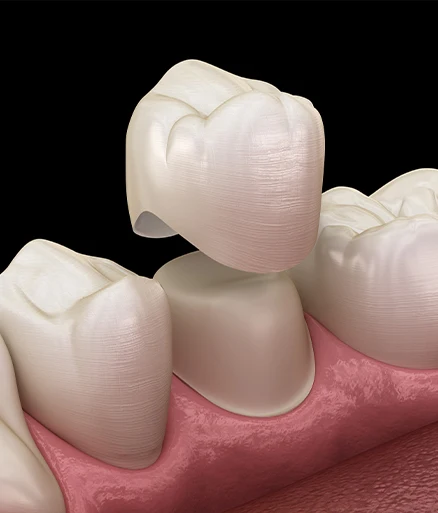 Same Day Crowns