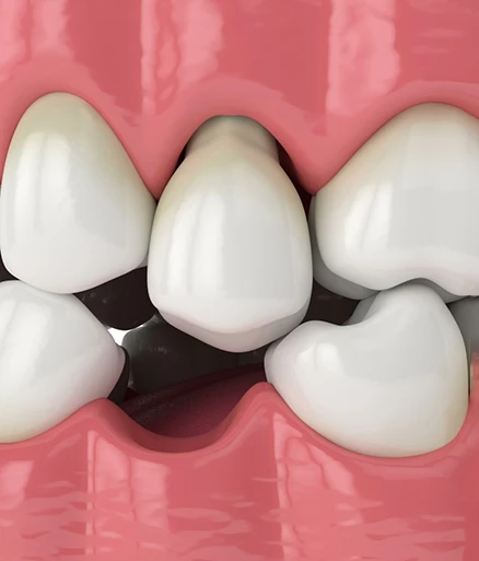 Tooth Extractions Tooth Extractions