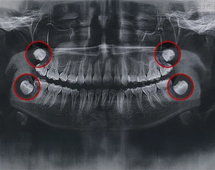 Wisdom Tooth Extractions Wisdom Tooth Extractions