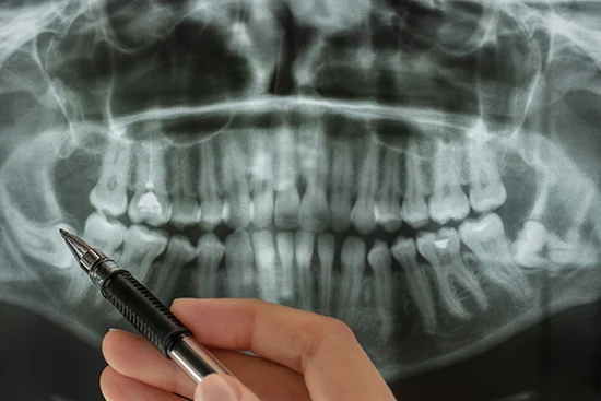 Wisdom Tooth Sedation Dentist