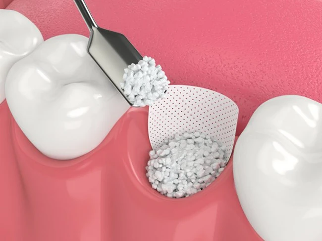 Bone Grafting Dentist 1 Bone Grafting Dentist 1