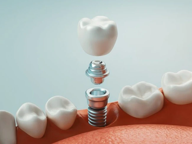 dental implant dental implant