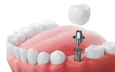 Dental Implants