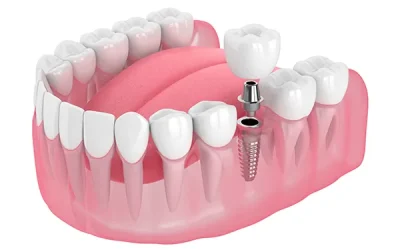 Best dental implant options