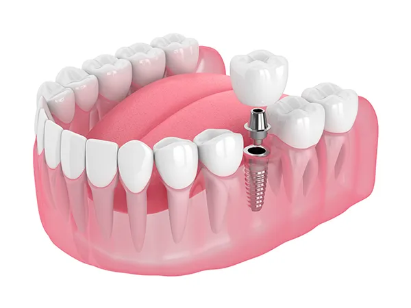 Best dental implant options Best dental implant options