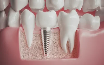 Dental Implants