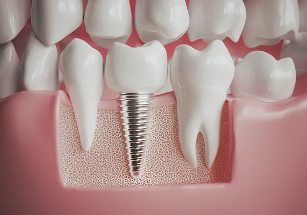 Dental Implants Dental Implants